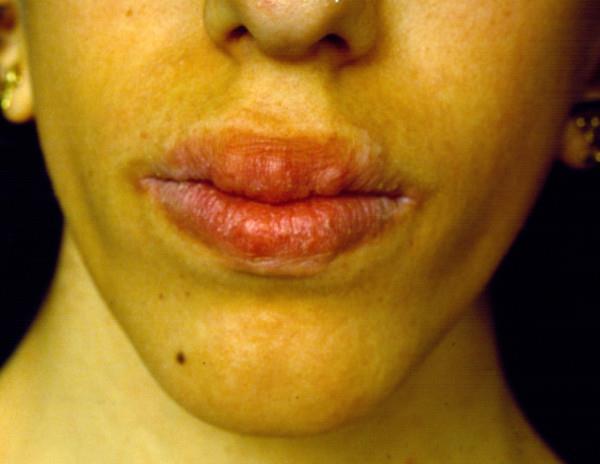 Question 7. An adolescent female complains about her tall stature. On physical exam you notice some nodules on her lips and tongue. She has a history of severe constipation.