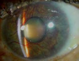 New blood vessel growth at the pupillary border, iris surface, and iris angle leads to formation
