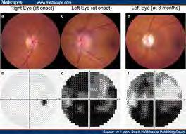 Ocular Effects of Diabetes Nonarteritic ischemic optic neuropathy: Symptoms: sudden, painless, nonprogressive visual loss of moderate degree, initially unilateral, but may