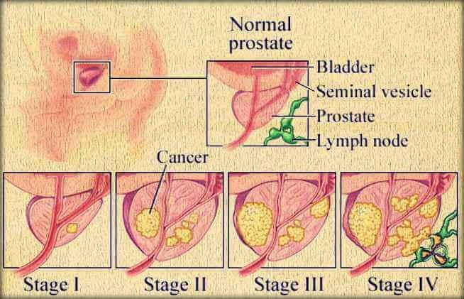 Staging of the prostate