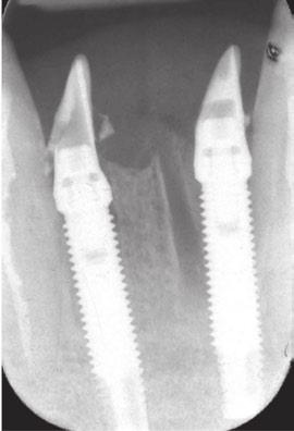 10-year follow-up of immediately loaded implants with TiUnite porous anodized surface Degidi M, Nardi D, Piattelli A Clin Implant Dent Relat Res 2012;14:828-838 Periapical radiographs Day of surgery.