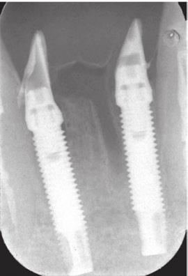 Original abstract Background: The immediate loading of implants with a porous anodized surface is a well-described technique. Few data are however available on the long-term outcomes.