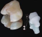1 They extracted 241 mandibular and 25 maxillary teeth, performed limited alveoloplasty and placed implants immediately in the extraction sites.