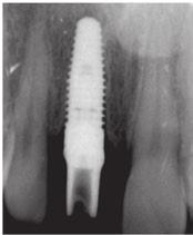 (2004), the authors conclude that early implant placement after extraction consistently results in reduced dehiscence defects.17 Atieh et al.