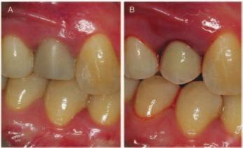 Maintenance of soft tissue esthetics In their series on 30 consecutive patients, Cosyn et al.
