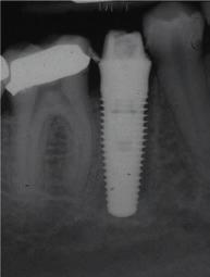 Immediate Loading of Tapered Implants Placed in Postextraction Sockets: Analysis of the 5-Year Clinical Outcome Mura P Clin Implant Dent Relat Res 2012;14:565-574 Radiographs on day of surgery