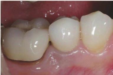 A further application of immediate loading protocol, although still controversial, especially when replacing single maxillary teeth in the anterior zone, is the immediate implant placement and