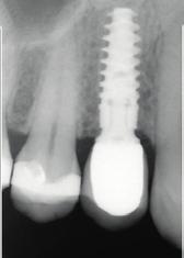 Prerequisite 4 careful patient selection The challenge of abandoning a delayed loading protocol in favor of immediate loading lies in the imposing forces on the endosseous implants.