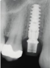 bone-to-implant contact.