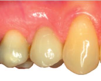 Degree of edentulism and presence of any nearby teeth. Prosthetic parameters such as rigidity of the prosthetic restoration, occlusal surface area, and cantilevers.