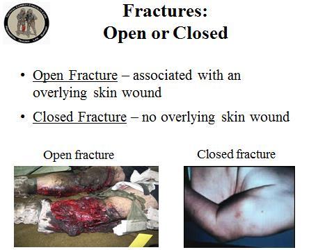Read the guideline. Fractures: Open or Closed 14.