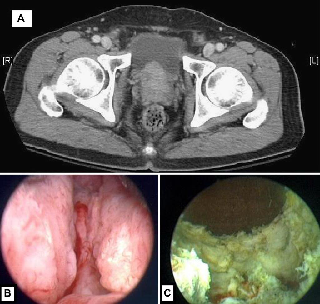 PVP in advanced PC patients 137 Figure 1 (A) Preoperative computed tomography showed advanced prostate cancer with extracapsualr invasion; (B) preoperative cystoscopy showed bladder outlet