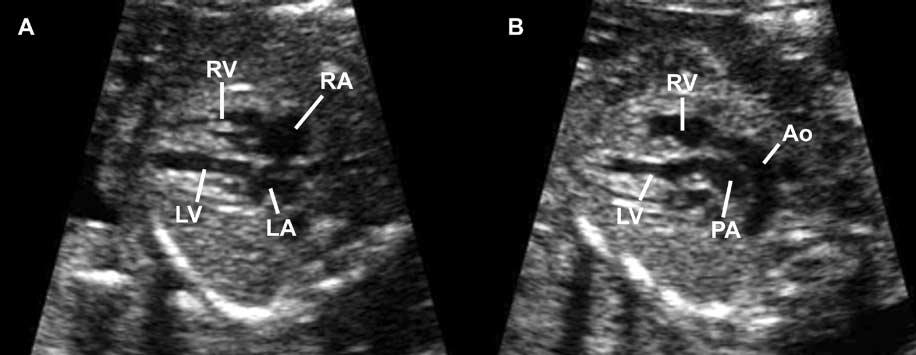Gonçalves et al Figure 1. Two-dimensional ultrasonographic images of TGA. A, Normal 4-chamber view of the fetal heart. B, Visualization of the outflow tracts.