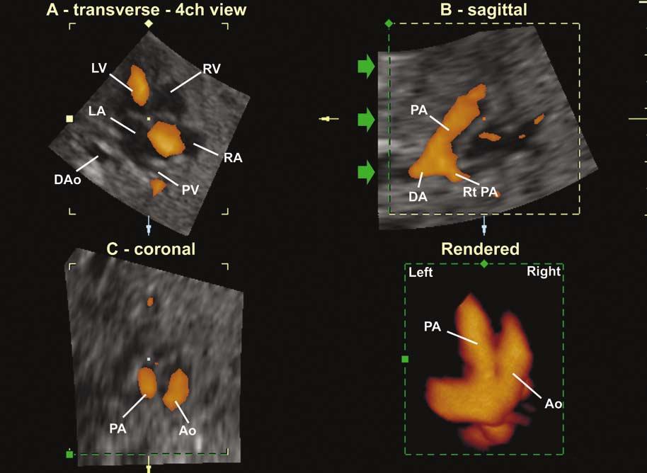 Gonçalves et al Figure 4. Rendered images from volume data sets of the fetal heart in a normal case 5 (A) and TGA (B).