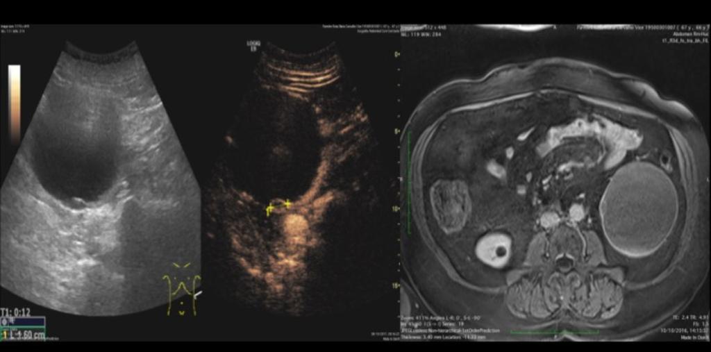 Fig. 9: Comparation of contrast uptake in a renal cyst - CEUS vs RM.