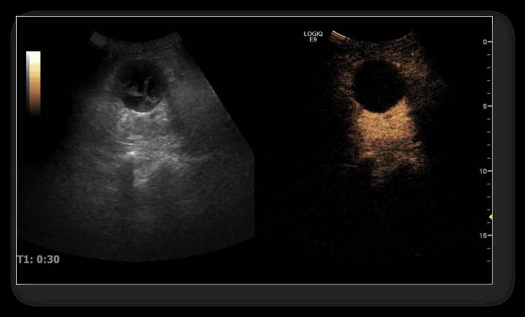 Fig. 2: Complex kidney cyst detected on
