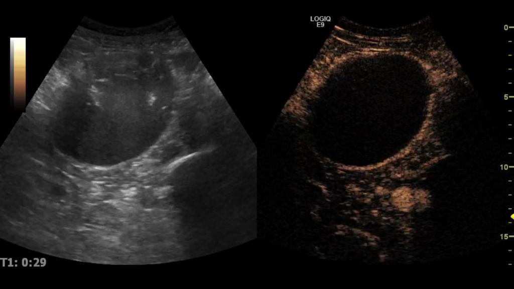 Fig. 3: Complex kidney cyst detected on US, with thick internal septa. CEUS allowed prompt assessment of the cyst, showing no internal enhancement - Bosniak I. Probable hemorrhagic cyst. Fig.