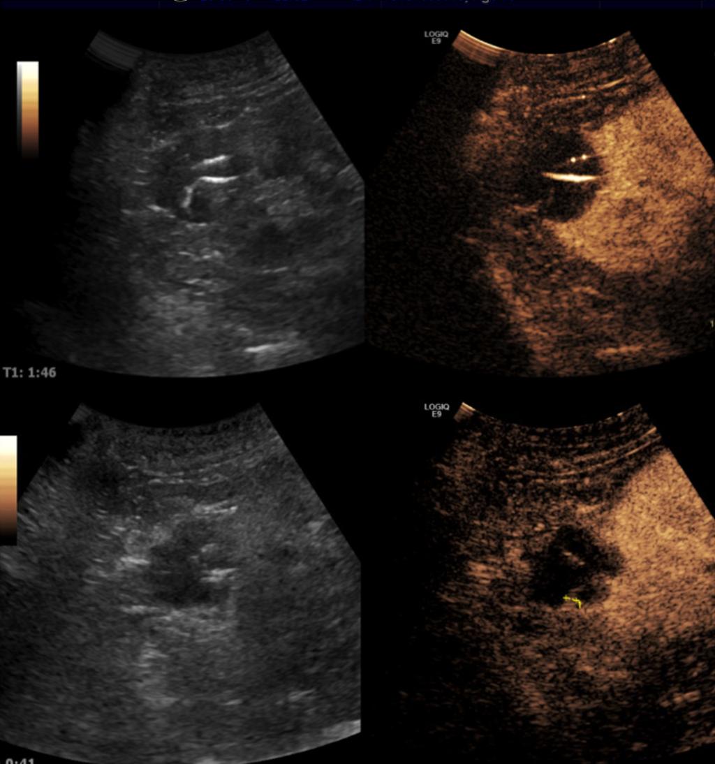 Fig. 6: A complex renal cyst with irregular borders, which sketches multiple septa, some calcified in its interior.