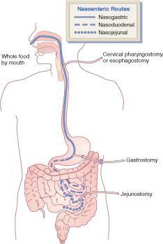 Enteral nutrition Placement of tube - Gastric - Small bowel Duration of tube feeding -