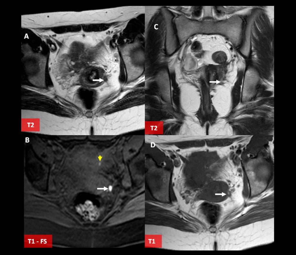 Fig. 6: Figure 6. Middle compartiment endometriosis. 36 y.o female with chronic pelvic pain.