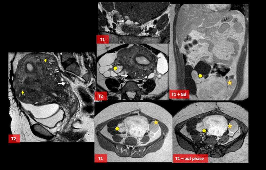 Fig. 8: Figure 8. Bowel endometriosic implants. 39 y.o female with massive uterus enlargemente and difusse adenomiosis (#).