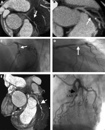 Coronary EBCT and MSCT angiography 637 Examples of images obtained using EBCTA and MSCTA are shown in figs 1, 2, and 3.
