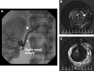 Noninvasive coronary angiography by retrospectively gated multislice spiral CT. Circulation 2000;102:2823 8. 19 Hong C, Becker CR, Bruening RD, et al.