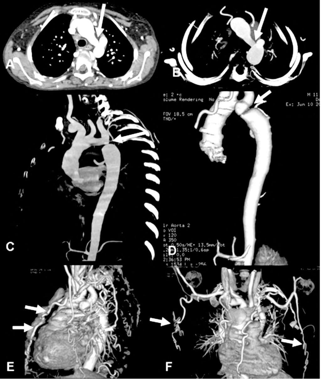 Mohamed Zaki & Mohamed Hassan 65 Fig. (1): CT images of a 11-year-old boy with severe coarctation of the aorta. (A): Axial contrast enhanced image showing the site of coarctation (arrow).