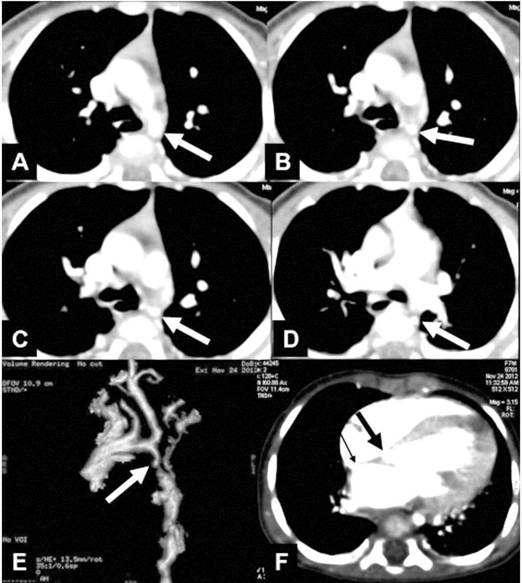66 Aortic Coarctation: Evaluation with Computed Tomography Angiography Fig. (2): CT images of a 7-month-old girl with severe long coarctation of the aorta.