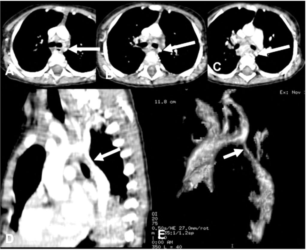 Mohamed Zaki & Mohamed Hassan 67 Fig. (3): CT images of a 2-year-old boy with severe long coarctation of the aorta distal to the left subclavian artery.