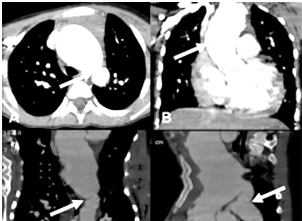 68 Aortic Coarctation: Evaluation with Computed Tomography Angiography Fig. (5): CT images of a 8-year-old girl with coarctation of the aorta.