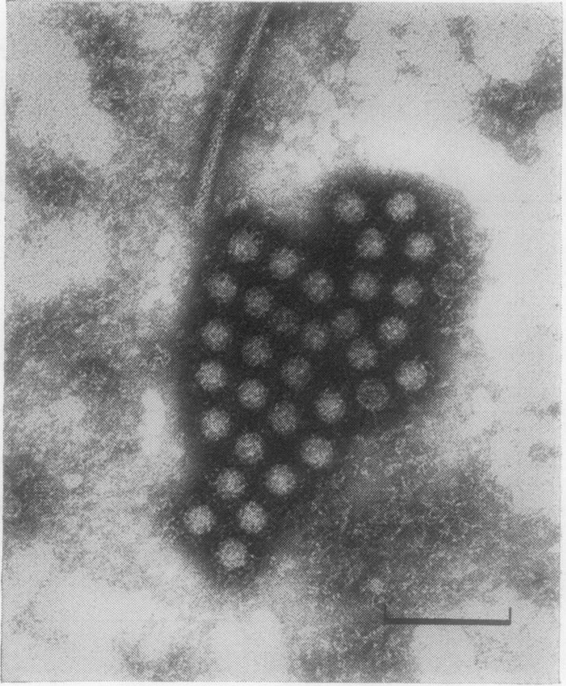 We suggest that this specimen had been examined too early for the detection of virus particles. A further specimen could not be obtained from this at the time of symptoms.