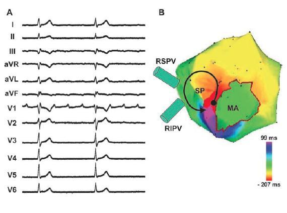 During activation mapping LAF is suspected : Sequential conventional mapping: RA activation time < 50% of TCL PPI in the RA > TCL by 40 ms in 3
