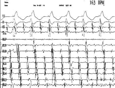 ECG pattern Atypical RA flutters (e.g.