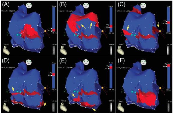 substrate mapping Isochronal representation provides a more real indication of conduction pattern IVC TA TA IVC Isochronal map of activation You only get what you explore
