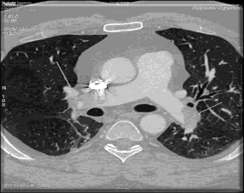 64 CT OF THORAX Nonoclusive massive thrombi of booth pulmonary arteries and lobar and segmental branches no pulmonary artery CT obstruction