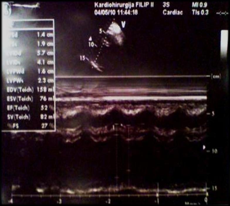 F O L LOW U P E C H OCARDIOGRAPHY - at one mounth-complete