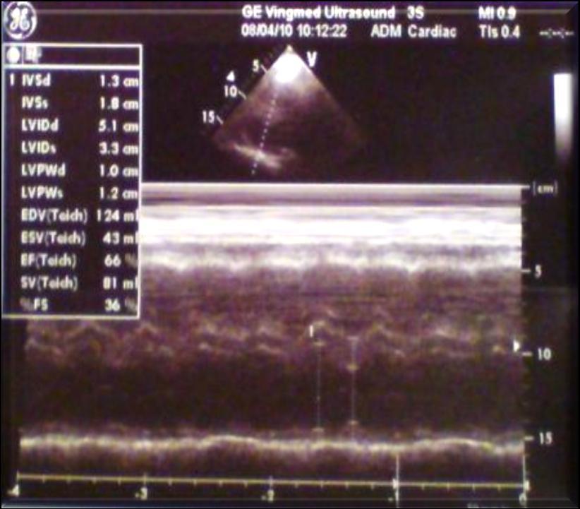 2D TT ECHOCARDIOGRAPHY LV with normal