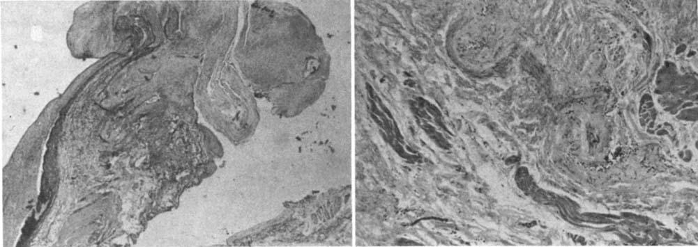 Photomicrographs of the membranous diaphragm removed from the junction of the right upper pulmonary vein and left atrium, showing intimal fibrous thickening and muscle bundles scattered in the