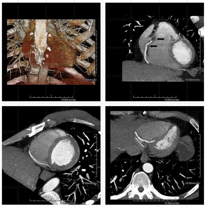 Figure 3: 47-year-old male underwent cardiac CT which shows step-stair and banding artifacts.