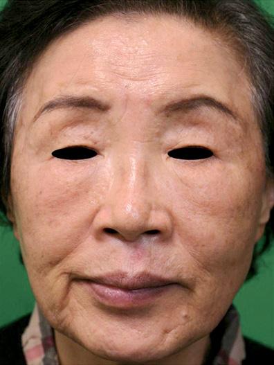 Fig. 2. A patient who received one treatment session of 1,550/1,927 combination. Considerable improvement in pigmentation was noticed after treatment.