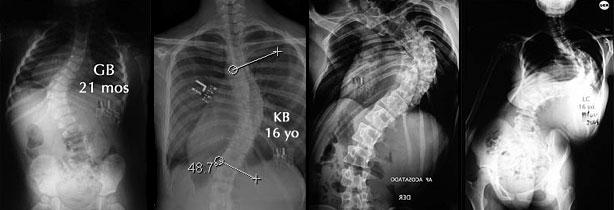 Adolescent Idiopathic Scoliosis Management It is important to