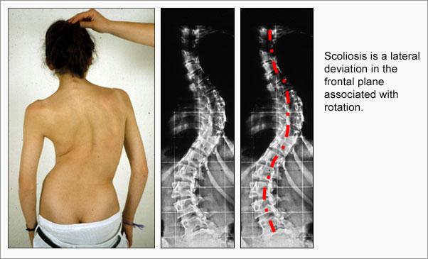 Adolescent Idiopathic Scoliosis A typical case would be a young pacent whose parents