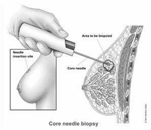 Diagnostic Staging Procedure Only record positive procedures Do not code excisional biopsies with clear or microscopic margins 37 Surgical Treatment Lumpectomy followed by radiation Mastectomy