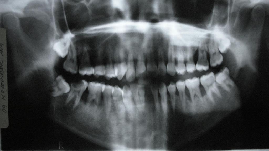 Pre op Panoramic and intra oral radiographic x ray