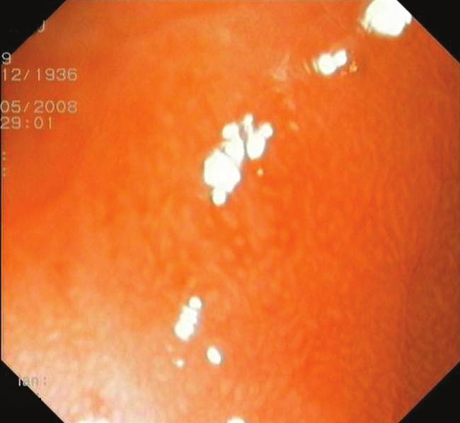 Hyperplastic polyps may show a reddish, coarse pattern on magnifying endoscopy, which reflects the enlargement of pits caused by congestion and edema of the interstitium.