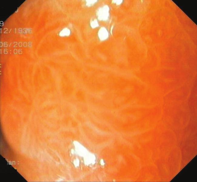 Magnification endoscopy with acetic acid has two objectives: identification of areas of intestinal metaplasia and the identification of dysplasia and superficial cancer within these areas.