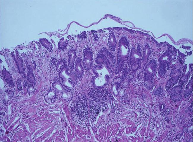 9 areas with hypervacularisation and irregular or absent surface pattern correspond to high grade intraepithelial neoplasia (HGIEN). The biopsy Fig 9.