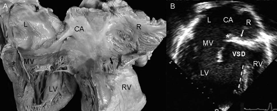 1184 Muñóz-Castellanos et al September 2006 Figure 1 A, Internal view of one specimen with common atrium (CA) associated with absence of right atrioventricular connection in situs solitus.