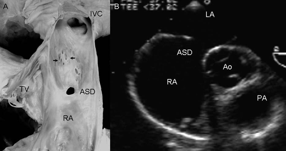 Figure 5 A, Internal view of right atrium (RA) shows atrial septal defect (ASD) within area of fossa ovalis (foramen secundum) in which remnants of left leaflet of sinus venosus can be seen adhering